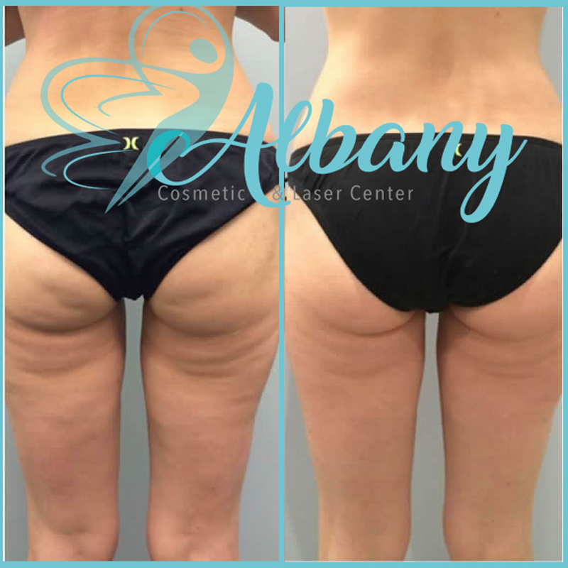 Three stage for CoolSculpting