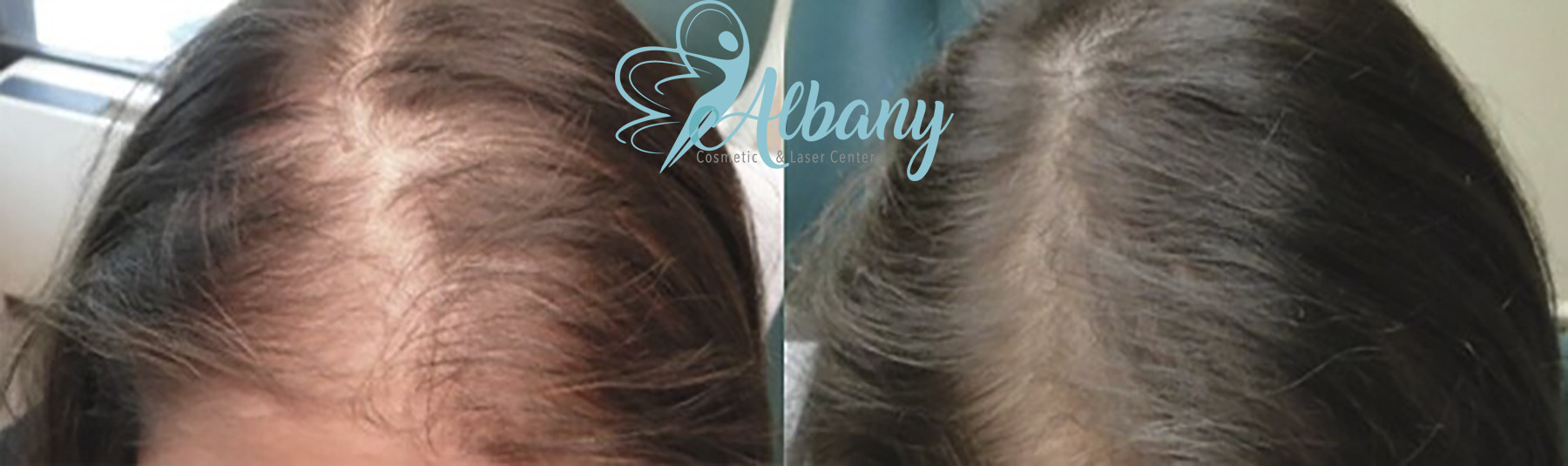 Using Plasma Mesotherapy Injection And Micro Needling For Hair