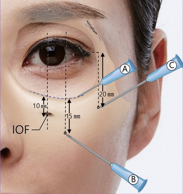 under eye fillers injections