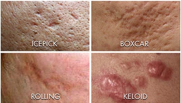 types of acne scars