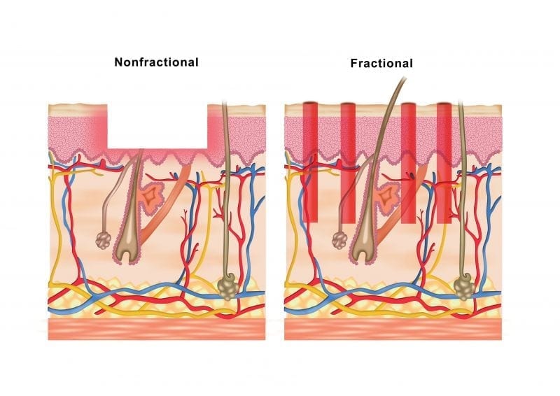 fractional laser