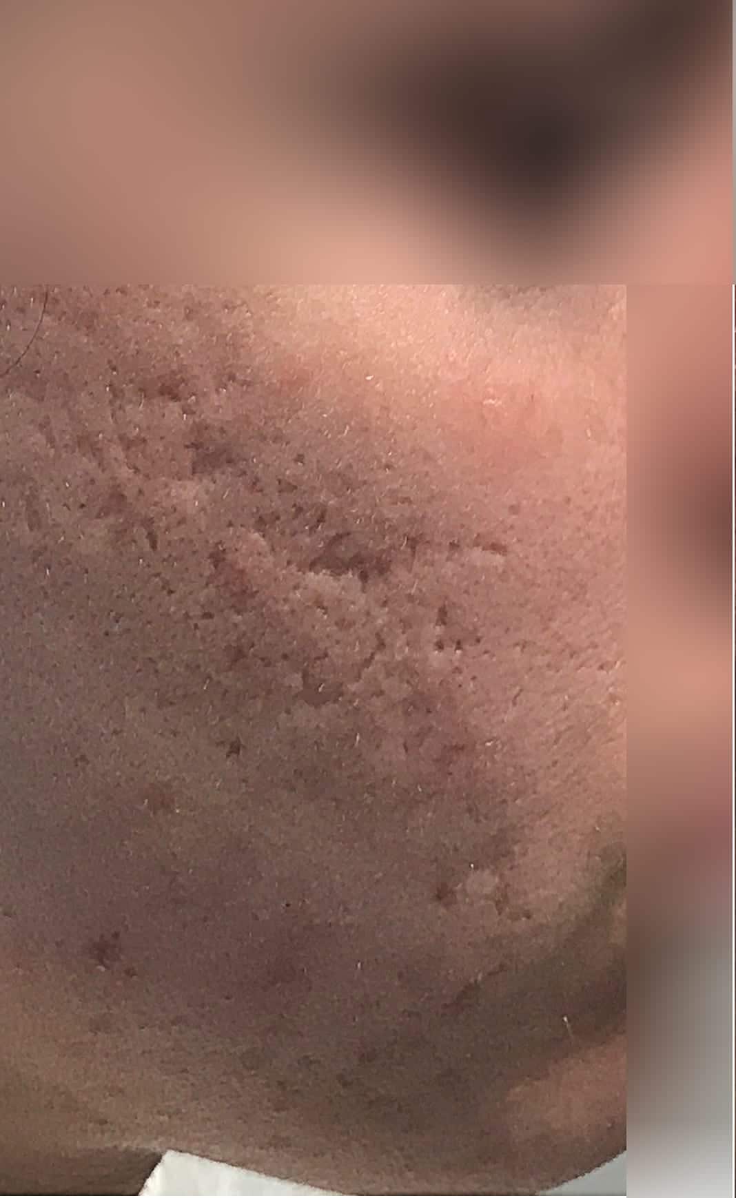 acne scars before nov 26th