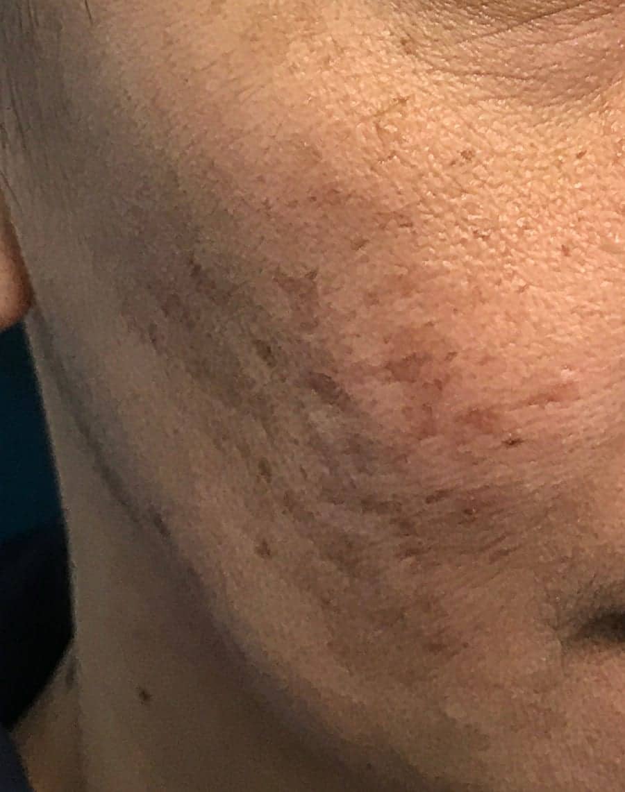 acne scars before
