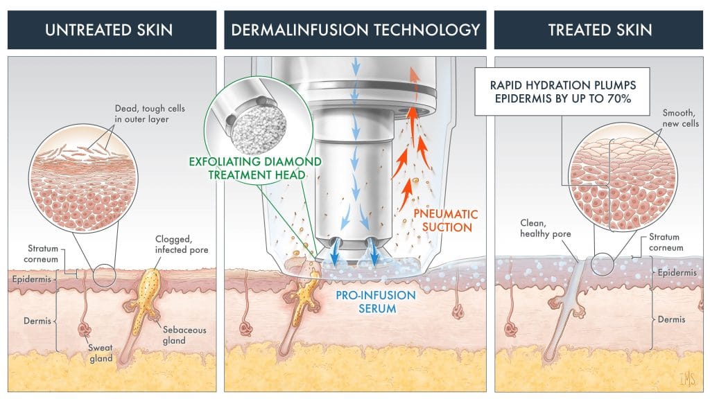 Microdermabrasion infographic