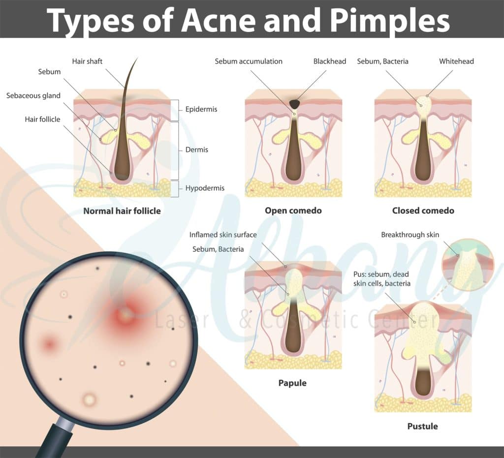 acne types infographic Edmonton