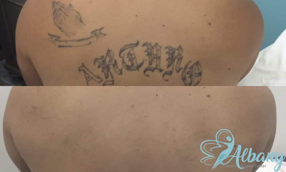 Laser Tattoo removal Edmonton