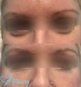 under eye bags Edmonton treated with fillers