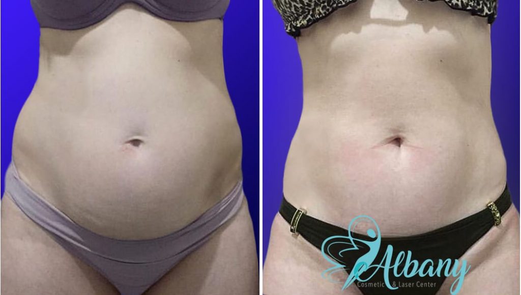 sculpsure edmonton before and after 1