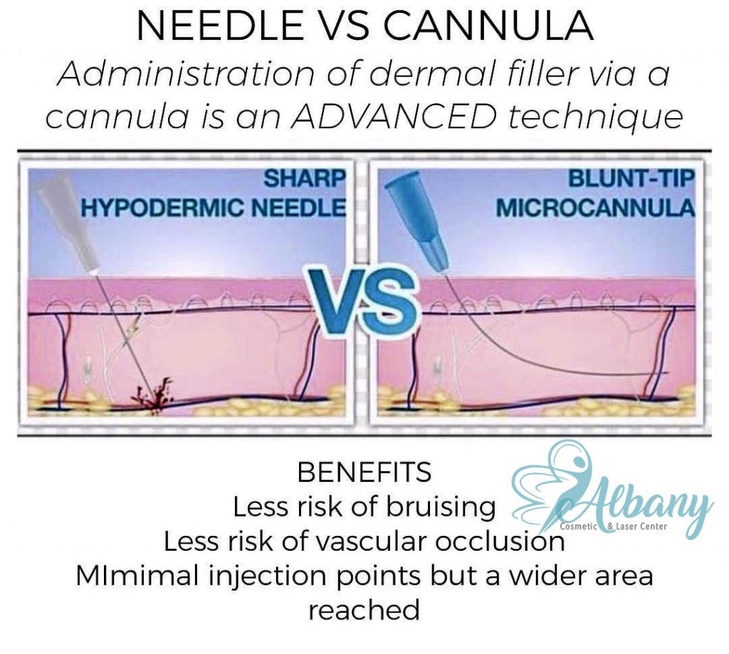 needle cannula infographic