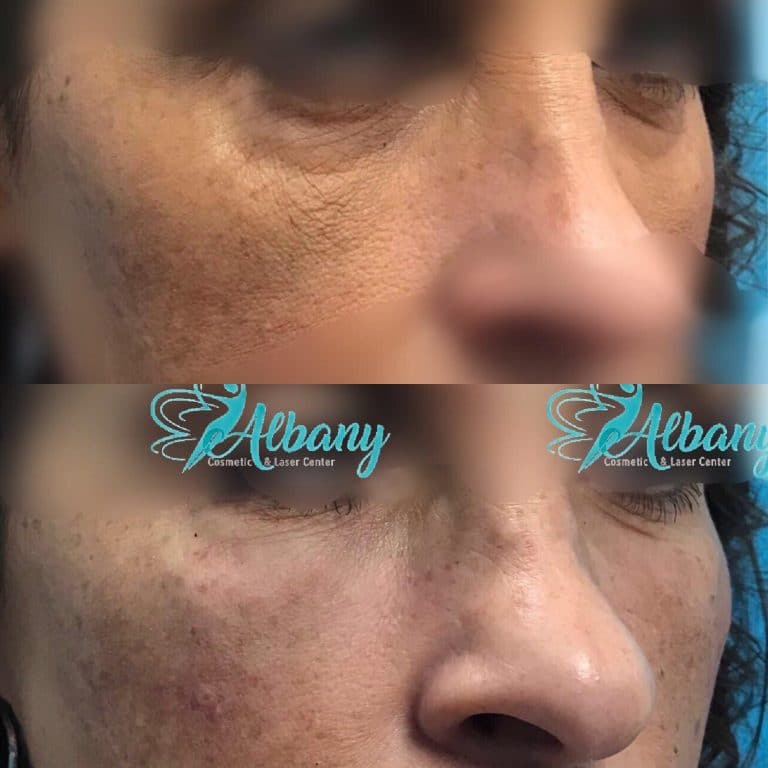 before and after undereye fillers in Edmonton