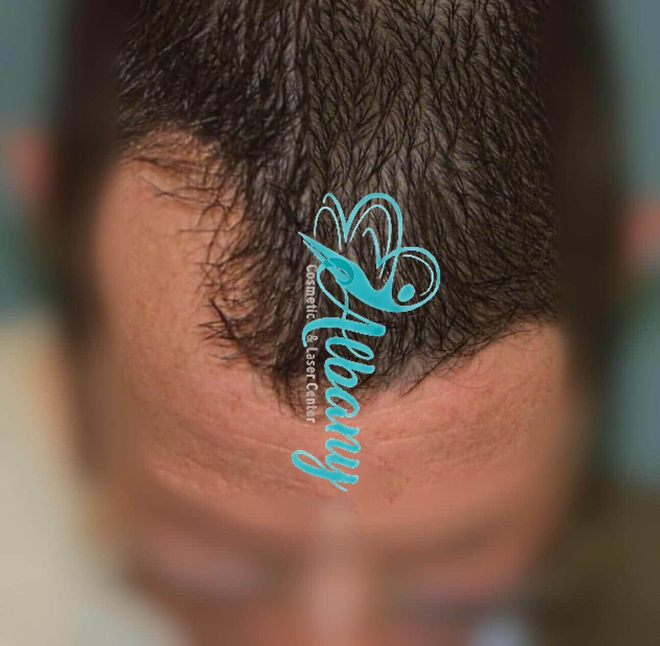 Before and after Hair loss treatment in Edmonton