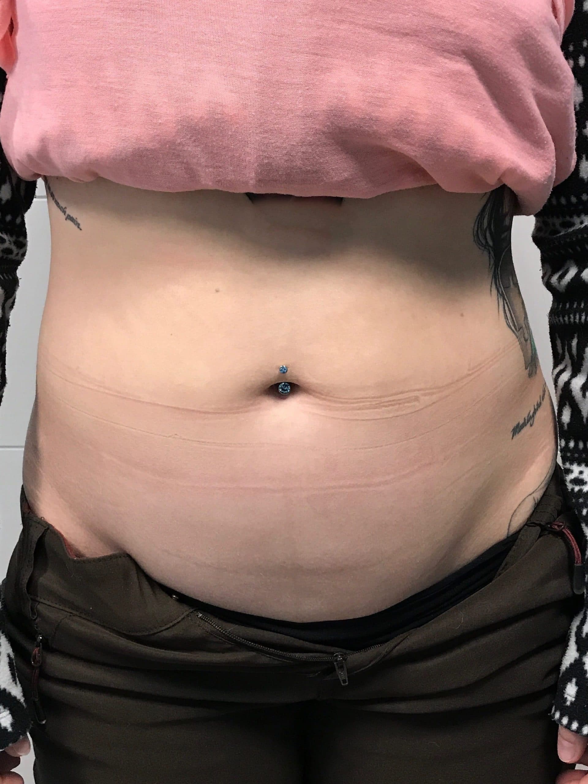 coolsculpting results in Edmonton