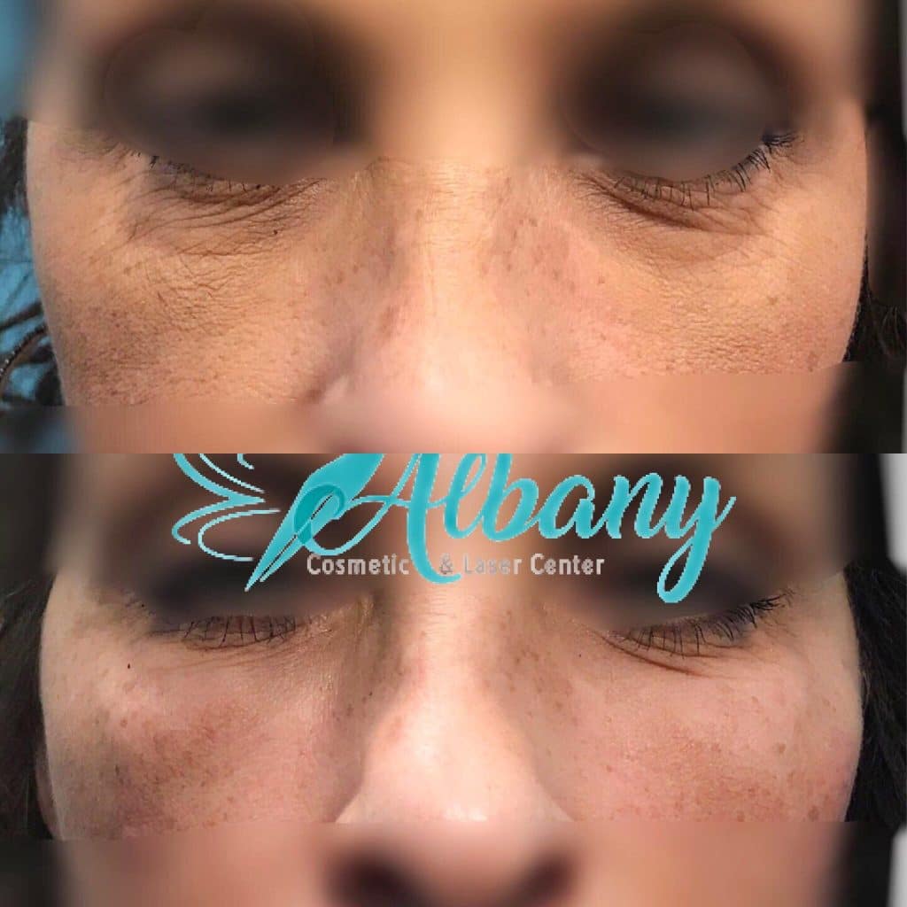 before and after under eye fillers treatment