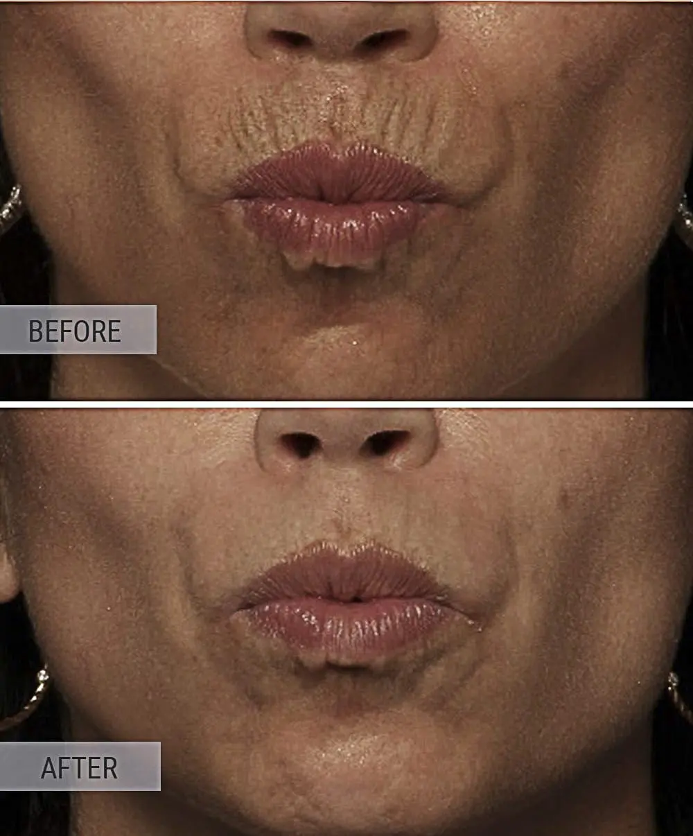 Botox For Lip Lines Albany Laser And Cosmetic Medical Spa In Edmonton Edmonton