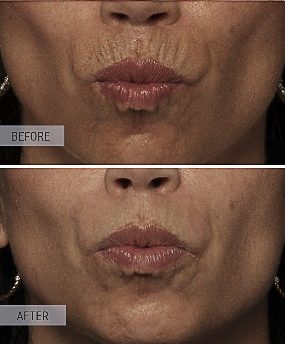 BOTOX FOR LIP LINES Albany Laser Cosmetic Medical Spa In Edmonton 