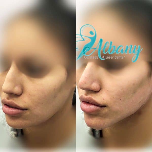 Facial Slimming Vancouver, BC  Non Surgical Jawline Treatment