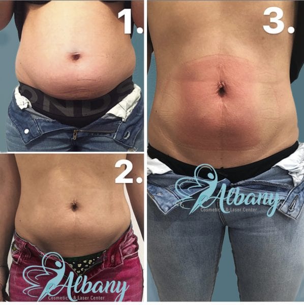 Fat Freezing with CoolSculpting in Edmonton