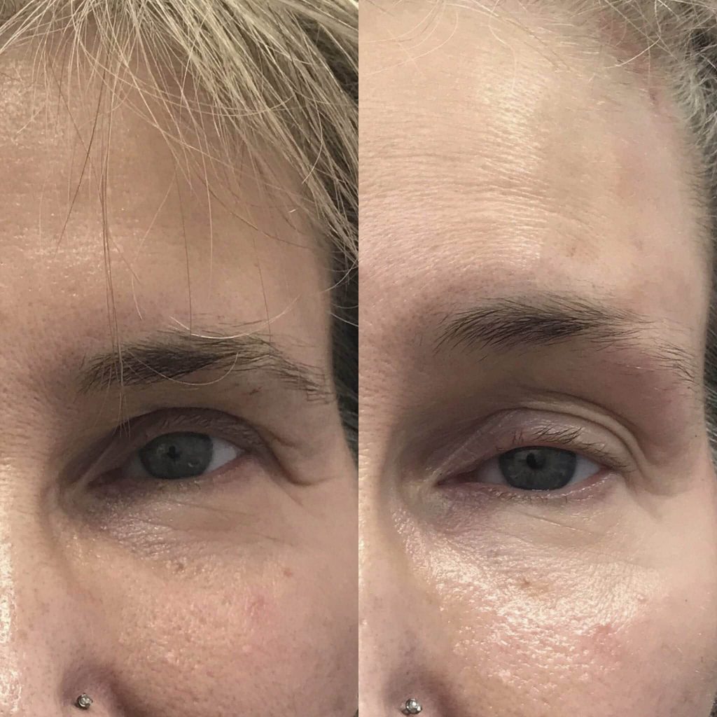 eye brow lift before and after