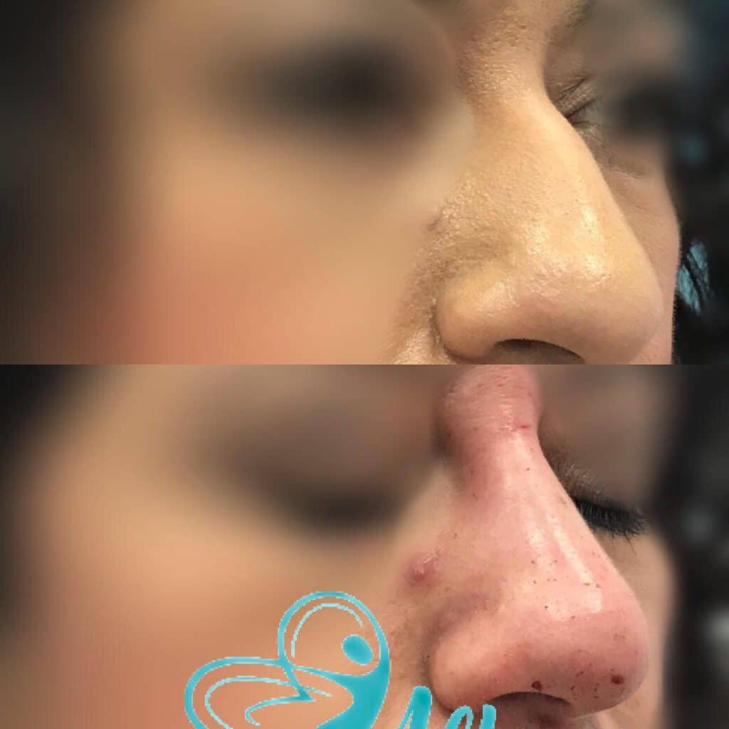 before and after nose job with fillers