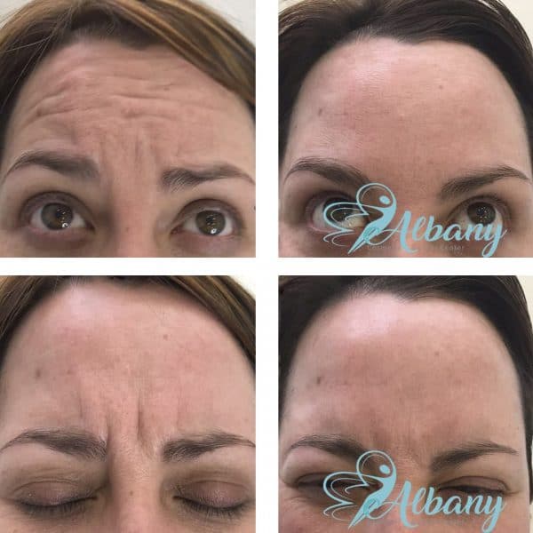Botox Glabella Edmonton before and after