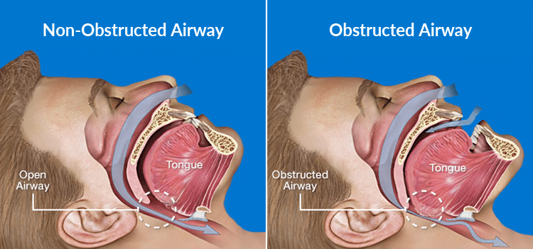 snoring-anatomical-features