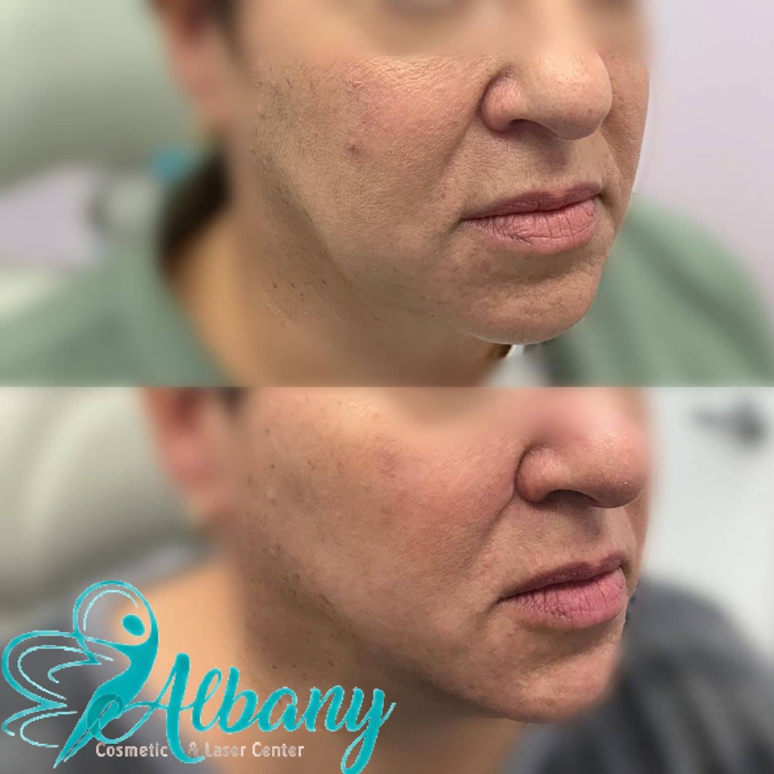jawline contouring
