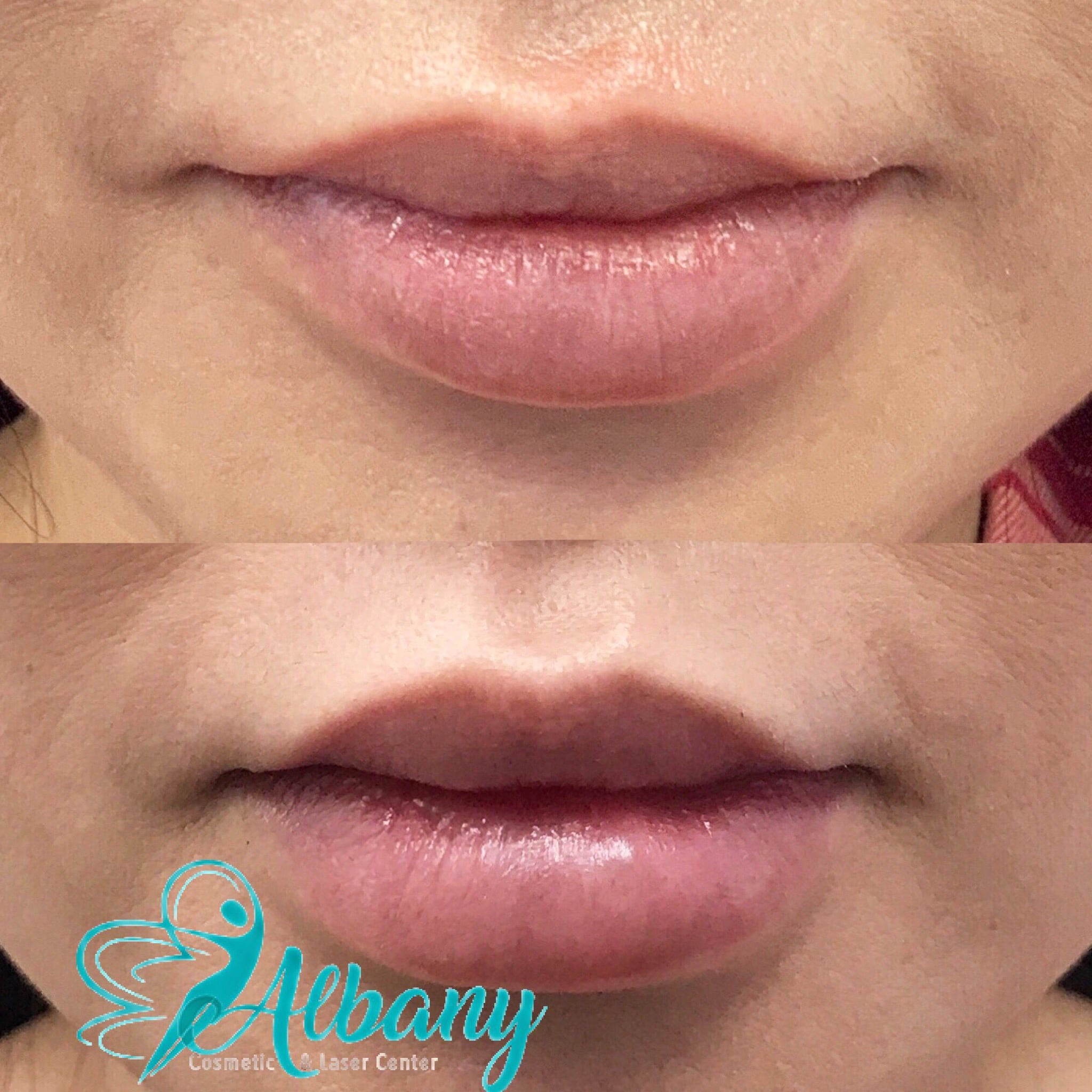 Lip fillers with Juvederm