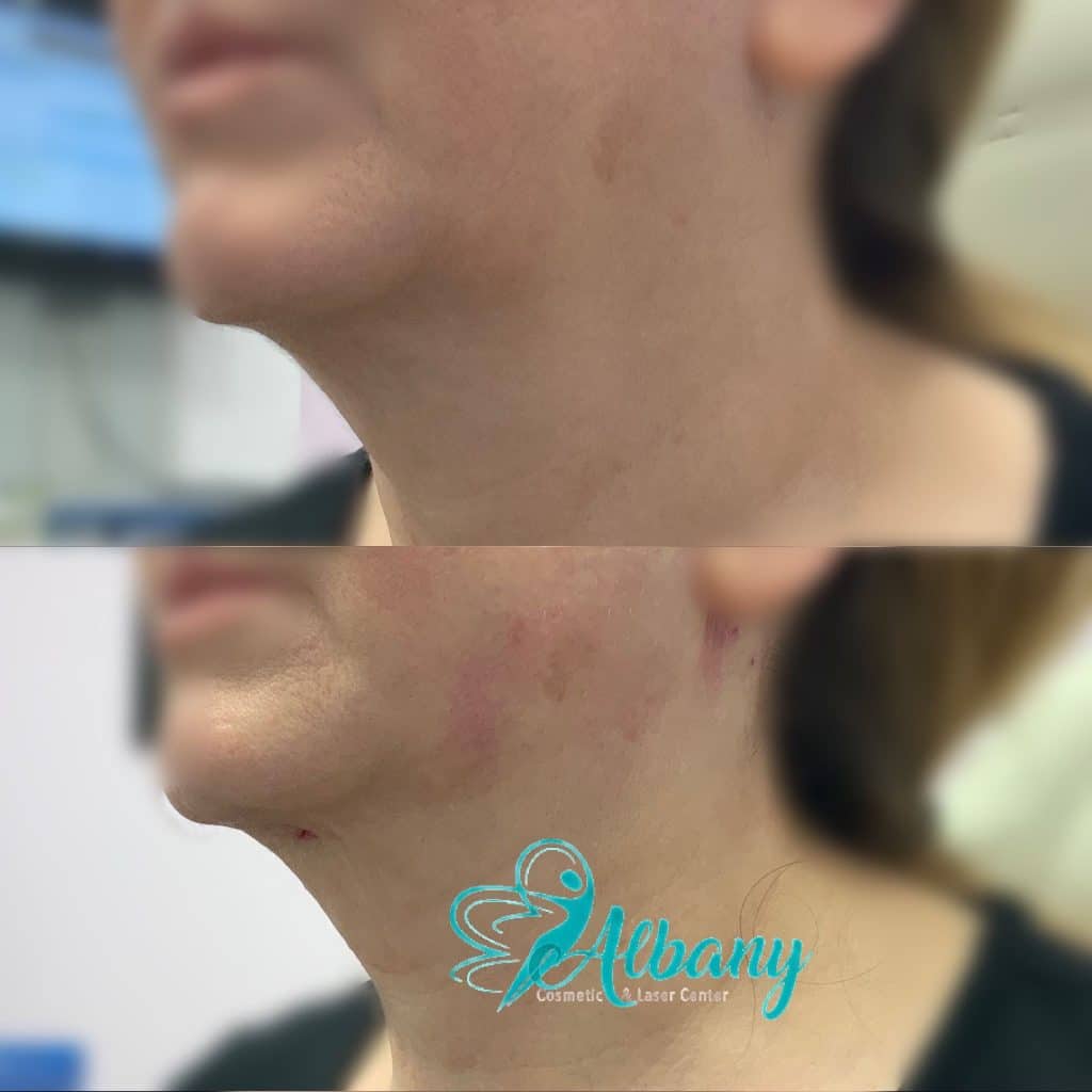 double chin and jowl removal