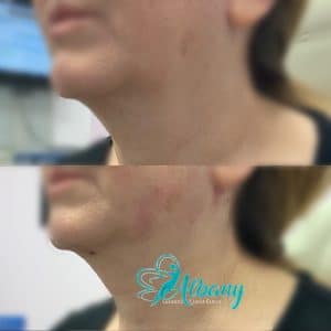 double chin and jowl removal