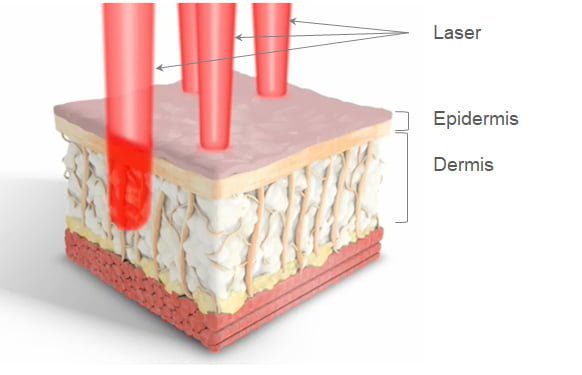 fractional laser