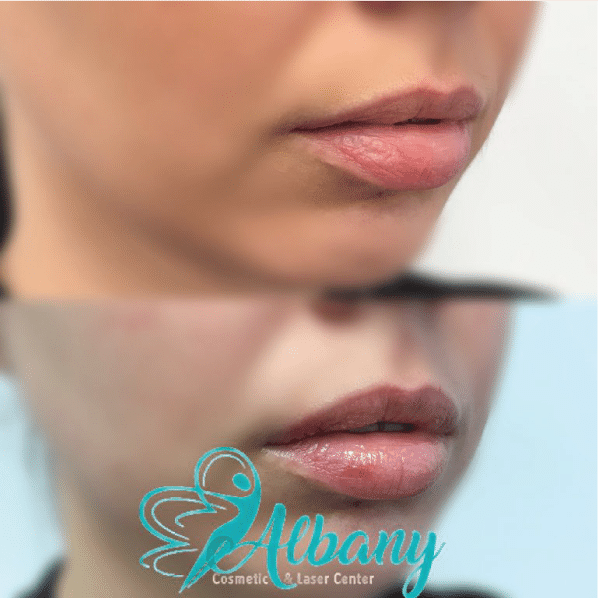 Laser lip fillers