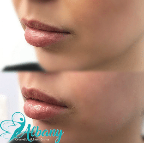 Laser lip fillers