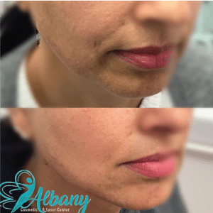 Jawline contouring with fillers in Edmonton