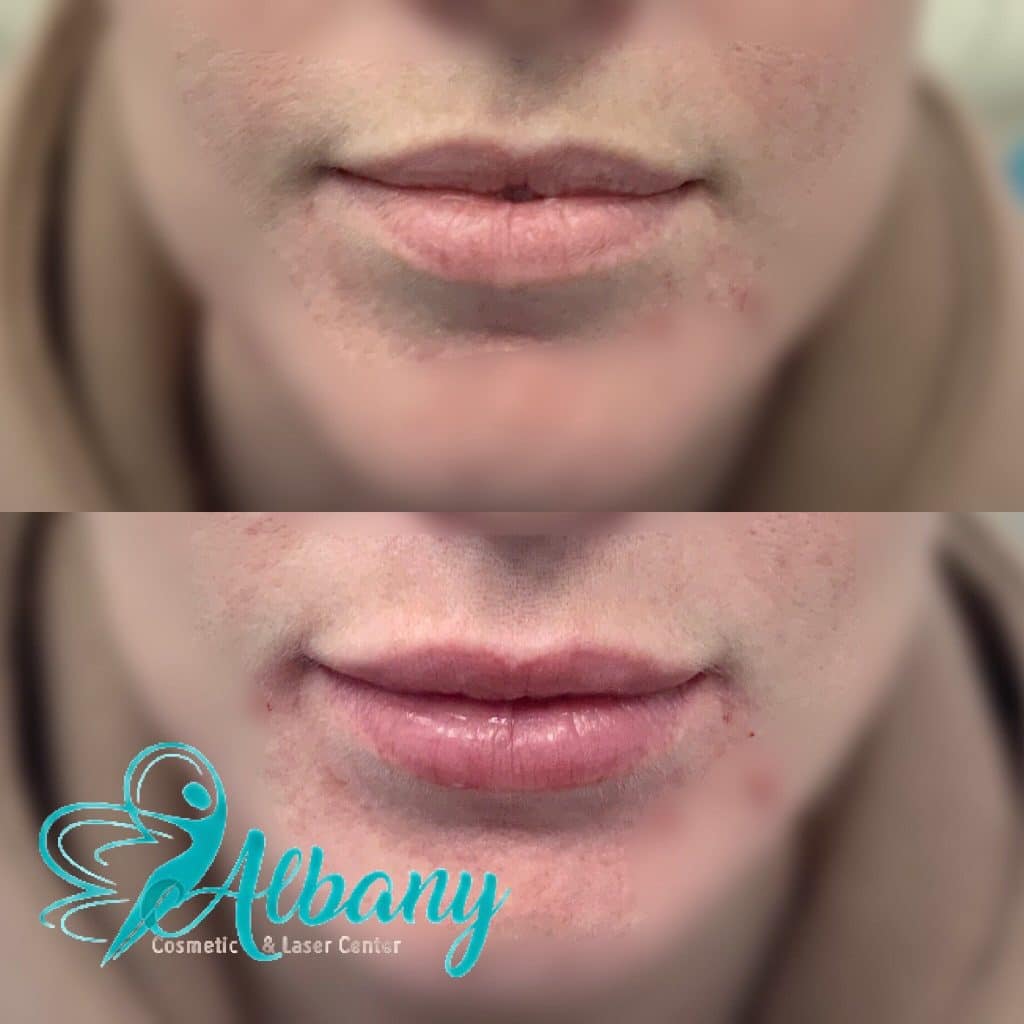 lip augmentation with Restylane