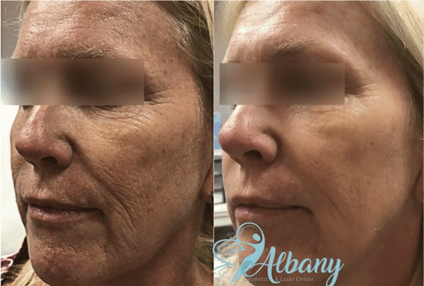 Vampire Facelift before and after