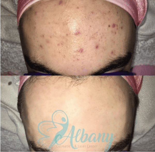 Acne Treatment in Edmonton Benefits, Cost, Results, Side Effect