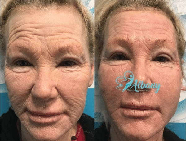 Befor and after vampire facelift in Edmonton