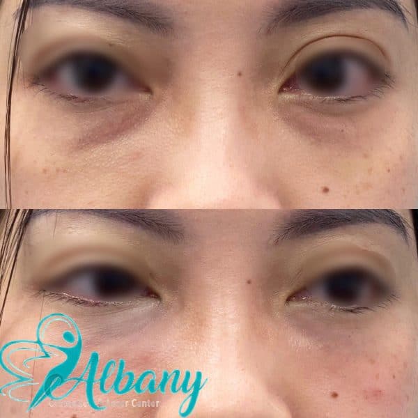 under-eye fillers Edmonton