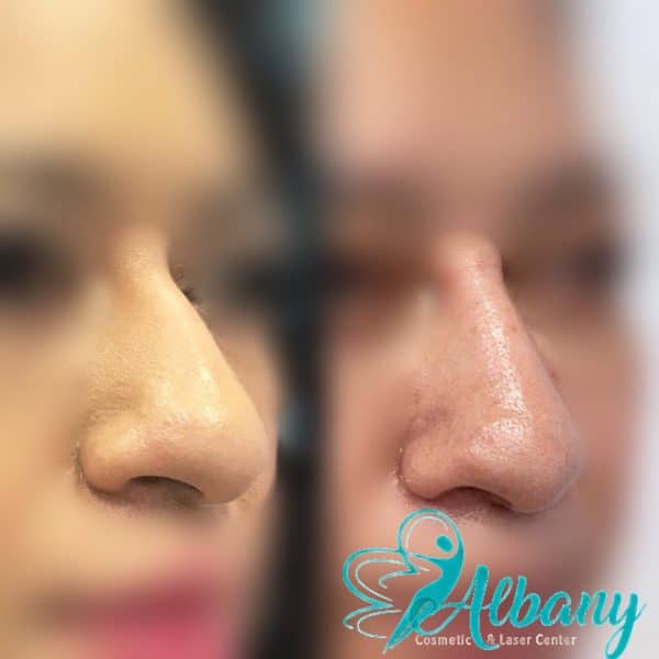 Non-surgical nose job