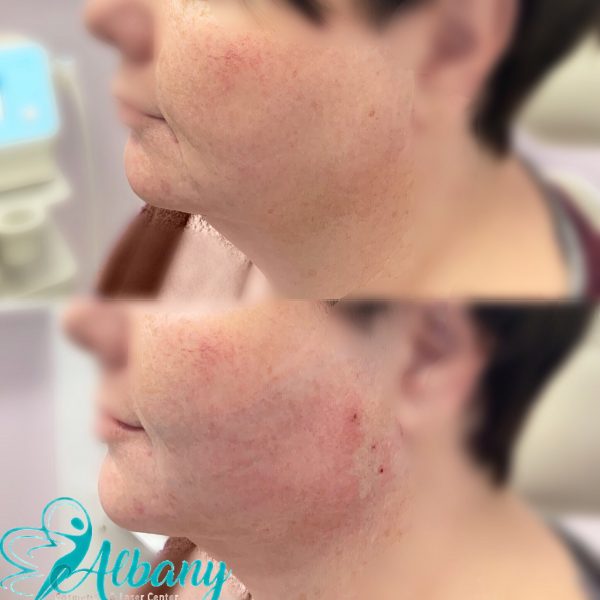 double chin correction with threads in Edmonton