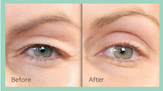 Eyebrow lift treatments in Edmonton Do not trust Laser