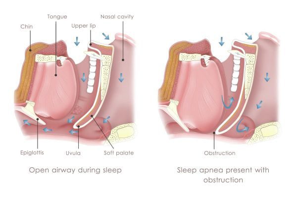 snoring causes