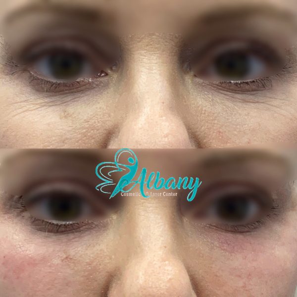 Under eye fillers Juvederm volbella