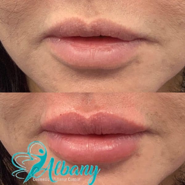 lip fillers in Edmonton