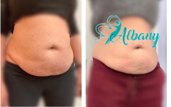 Before after coolsculpting