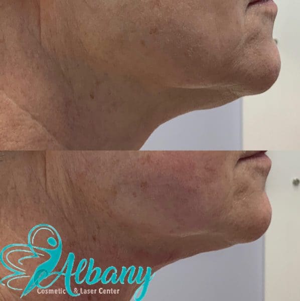 Ulthera facelift