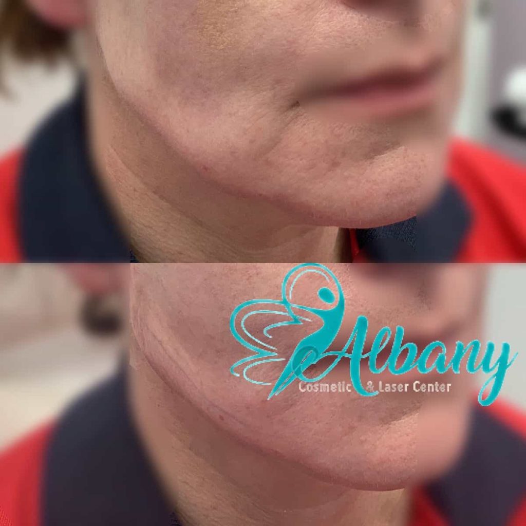 Jawline contouring threads