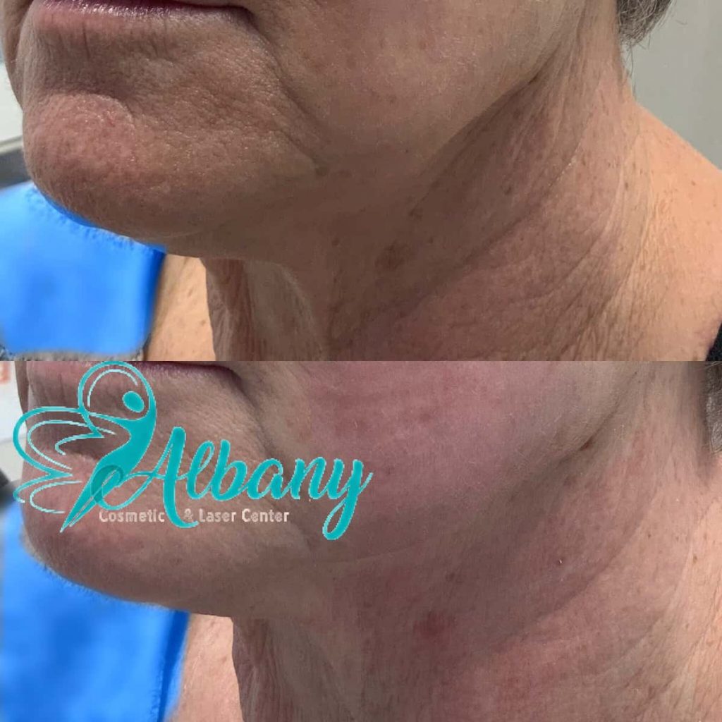 Ulthera treatment
