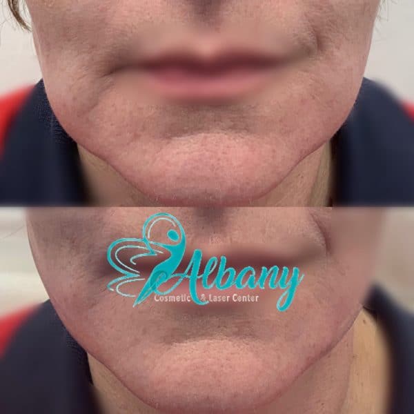 prejowl sulcus treatment