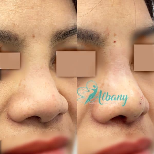 fillers nose job